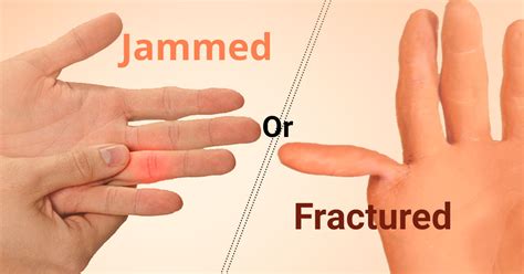 Have you Ever Jammed or Fractured your Finger? – MarhamMarham