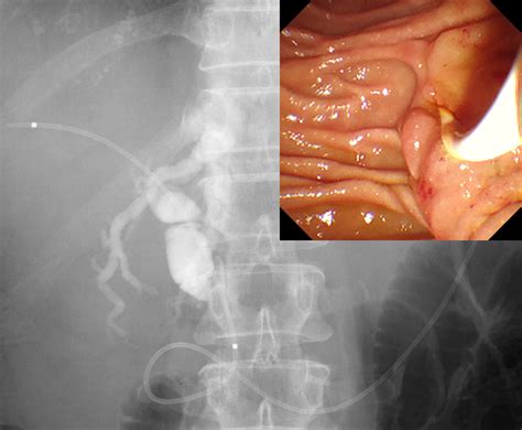 Indications and techniques of biliary drainage for acute cholangitis in ...