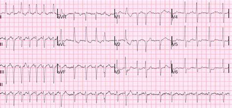 Dr. Smith's ECG Blog: Atrial Fib and RVR with a run of wide complex ...