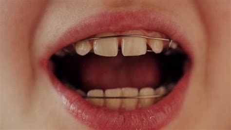 Smile Braces On Teeth Stock Footage Video (100% Royalty-free) 14091242 ...