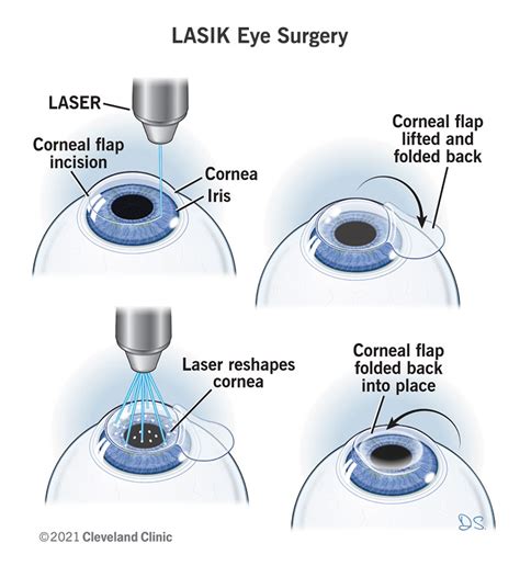 Understanding The Basics Of LASIK Surgery