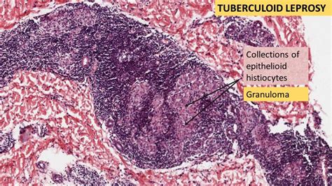 LEPROSY- Tuberculoid & Lepromatous | Pathology Made Simple