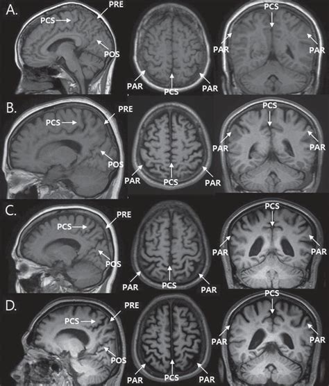 Posterior Cortical Atrophy