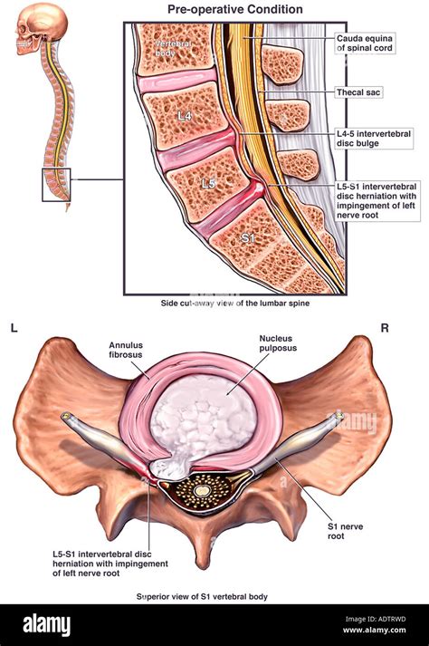 Low Back Injury - L4-5 Disc Bulge and Herniation Stock Photo, Royalty ...