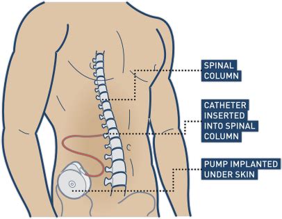 Baclofen Pumps Are Safe, Effective, and Highly Satisfactory to Patients ...