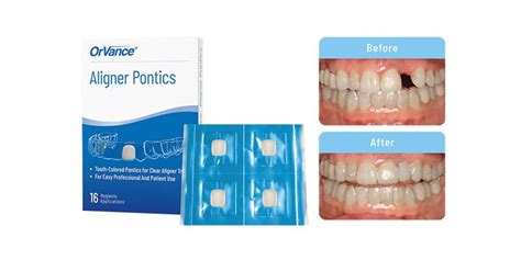 OrVance Launches Aligner Pontic Solution for Patient Use | Orthodontic ...