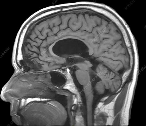 Chronic Post-Traumatic Brain Injury, MRI - Stock Image - C030/6063 ...