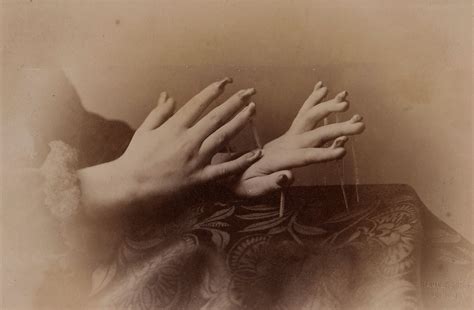 Hands of a girl affected with onychogryphosis | Wellcome Collection