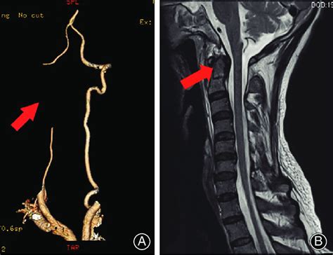 (A) 3D-CTA showed right vertebral artery occlusion (arrows), and the ...