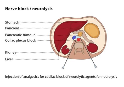 Neurolysis and plexus infiltrations – CIRSE