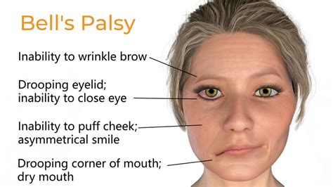 Bell’s Palsy Treatment - Propel Physiotherapy