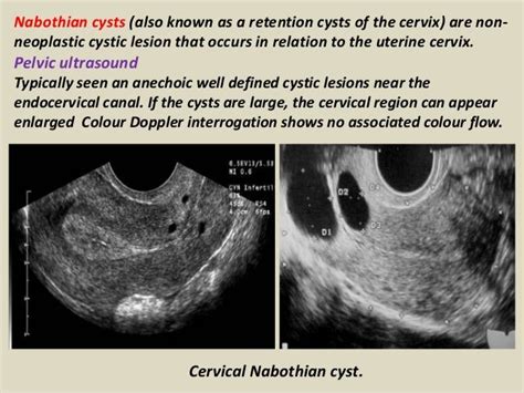 What Does Cervical Cancer Look Like On An Ultrasound - What Does