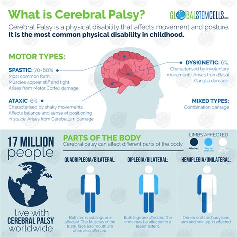 Cerebral Palsy Patient Emilio's Second Stem Cell Treatment