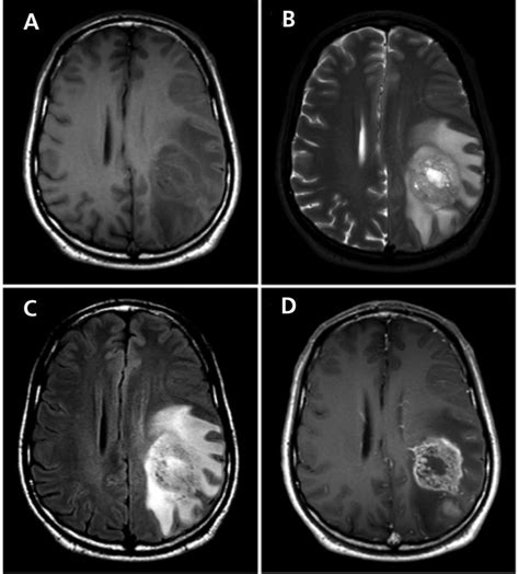 Brain Mri Tumor