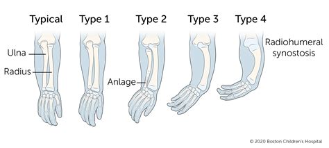 Ulnar Longitudinal Deficiency (Ulnar Club Hand) | Boston Children's ...