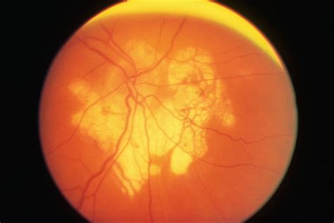 Posterior Pole Chorioretinal Atrophy With Staphyloma - Retina Image Bank