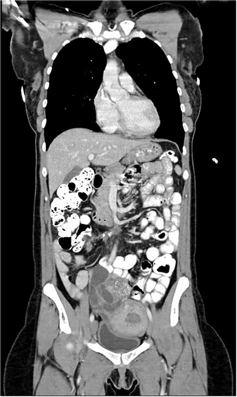 Abnormal Pelvic Ct Scan