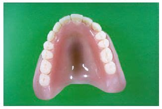 13 Denture Base Polymers | Pocket Dentistry