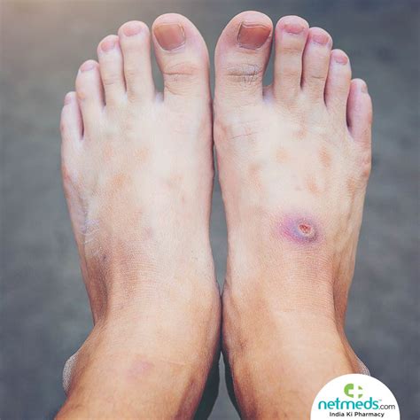 Gangrene : Causes, Symptoms And Treatment | Netmeds