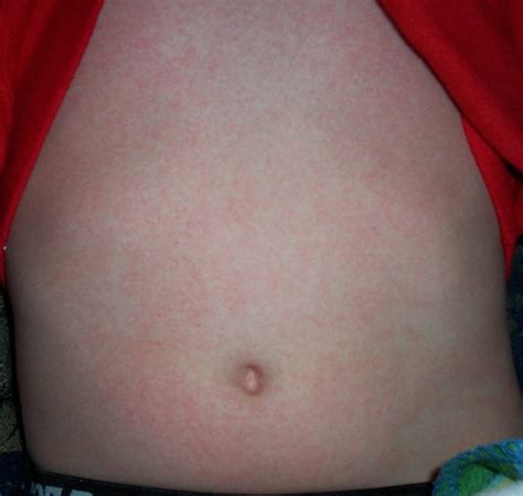 Scarlet Fever Rash Picture (Hardin MD Super Site Sample)