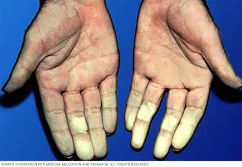 Limited scleroderma - Symptoms and causes - Mayo Clinic