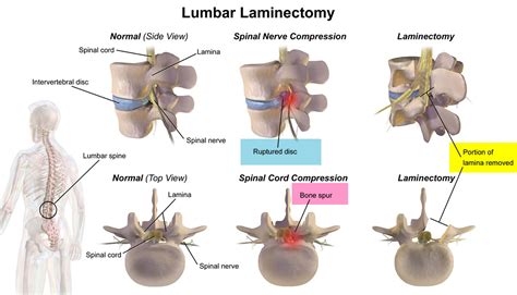 Laminectomy Surgery - Recovery & Laminectomy Complications