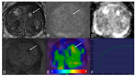 Cancers | Free Full-Text | Dynamic Contrast-Enhanced MRI of Prostate ...