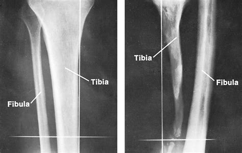 Bone disease - Metabolic, Osteoporosis, Osteomalacia | Britannica