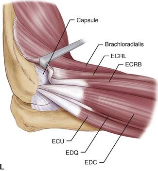 Elbow Flexion Contracture