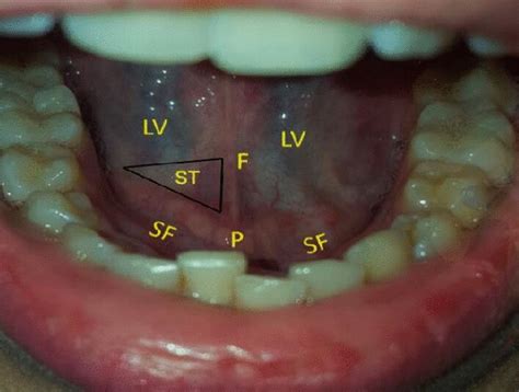 The sublingual cavity and floor of the mouth. F: lingual frenulum SF ...