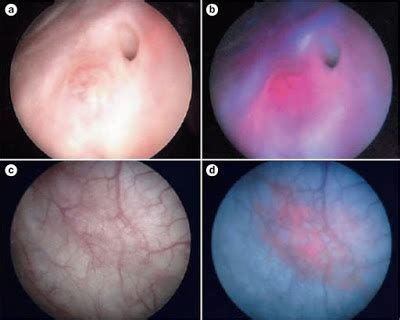 Cystoscopy for Bladder Cancer – Urology Care of Central New Jersey