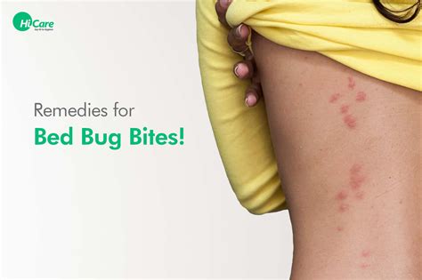 Top 10 Bed Bug Bites Treatment | HiCare