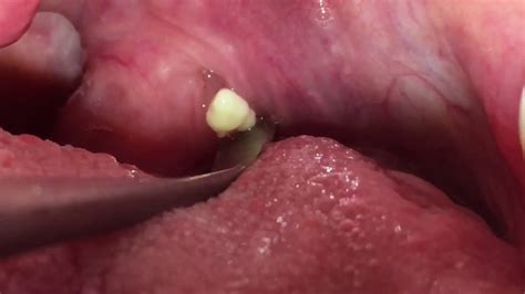 Tonsil Stone Removal #11 - YouTube