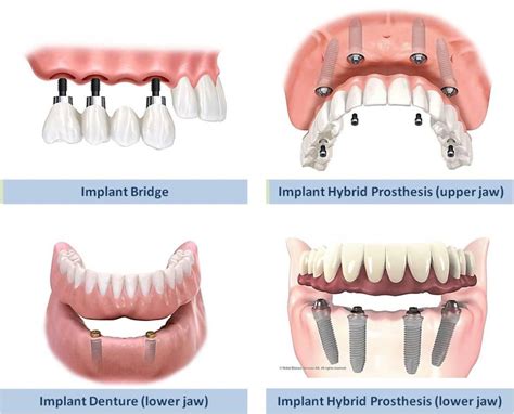 Types of Dental Implant Restorations | Dr. Coker & Dr. Ho