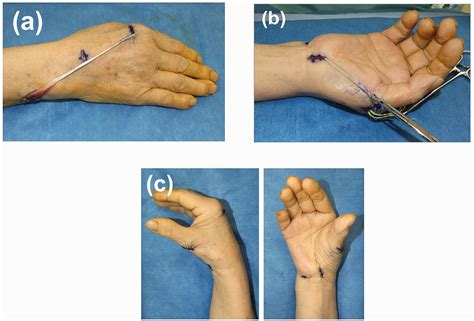 Opponensplasty using the extensor indicis proprius tendon for severe ...