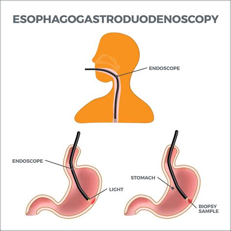 Upper GI Endoscopy | Gastro MD