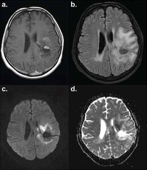 Mri Diffusion Weighted Imaging