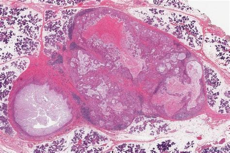 Mucoepidermoid carcinoma | Ottawa Atlas of Pathology