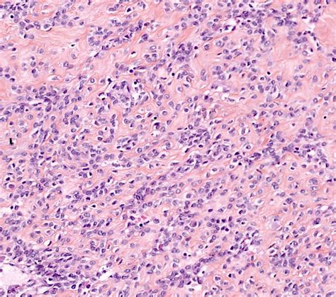 Pathology Outlines - Leiomyoma-general