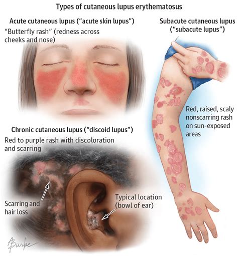 13 Early Warning Signs of Lupus You Need to Know (and what to do the ...