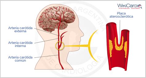 Enfermedad de las arterias carótidas - WikiCardio