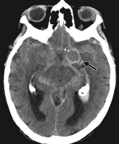 Cerebral Aneurysm Ct