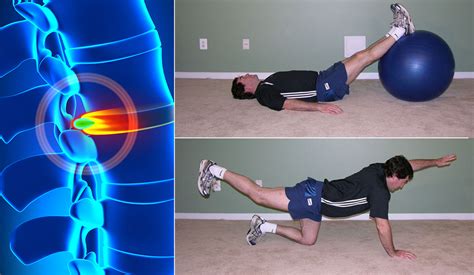 Herniated Disc Exercises: Easy and Simple Moves for Pain Relief