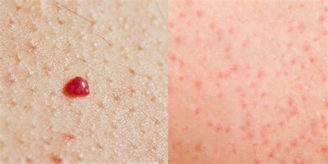 Blood Spots On Skin Red Tiny Raised Itchy Bumps Pictures Causes ...