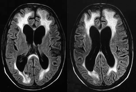 RADIOLOGY: HIV Encephalopathy