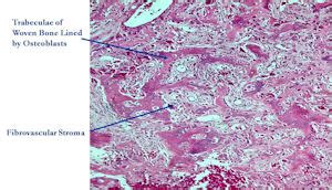 Osteoblastoma Histology