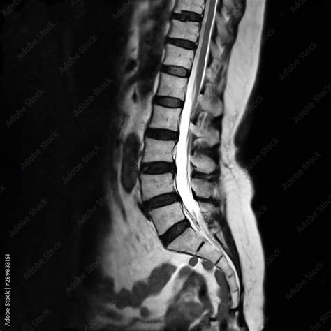 MRI L-s spine or MRI of lambosacral spine or L-S spine on sagittal ...