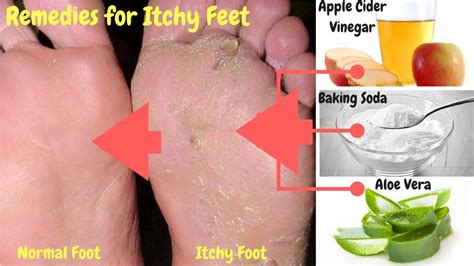 Follow These 5 Major Home Remedies For Itchy Feet - YouTube