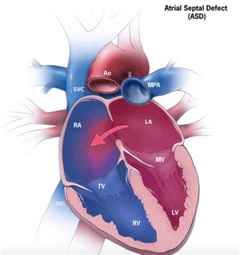 Atrial Septal Defect (ASD) – Cardio Guide