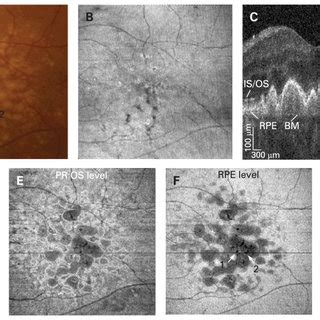 Basal laminar drusen. (A) Colour fundus photograph. (B) Fluorescein ...